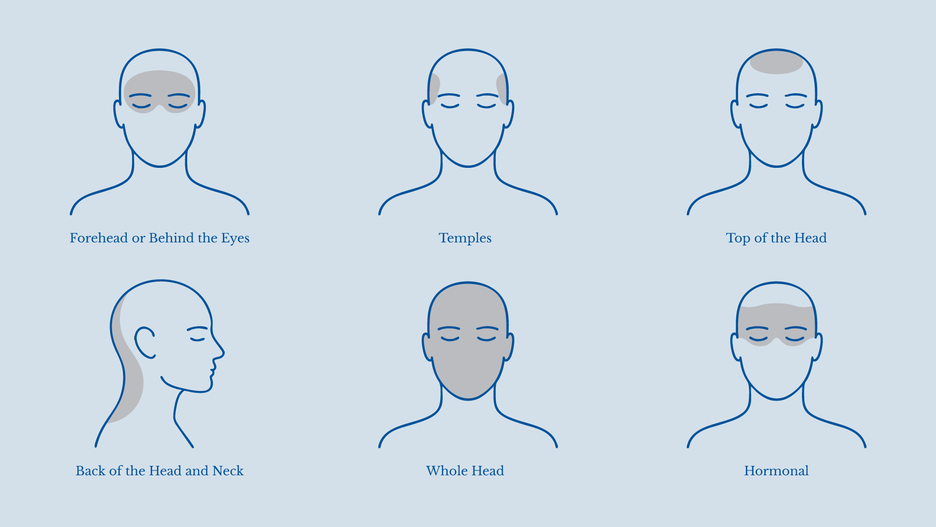 Heads Up: What Your Headache Location Means