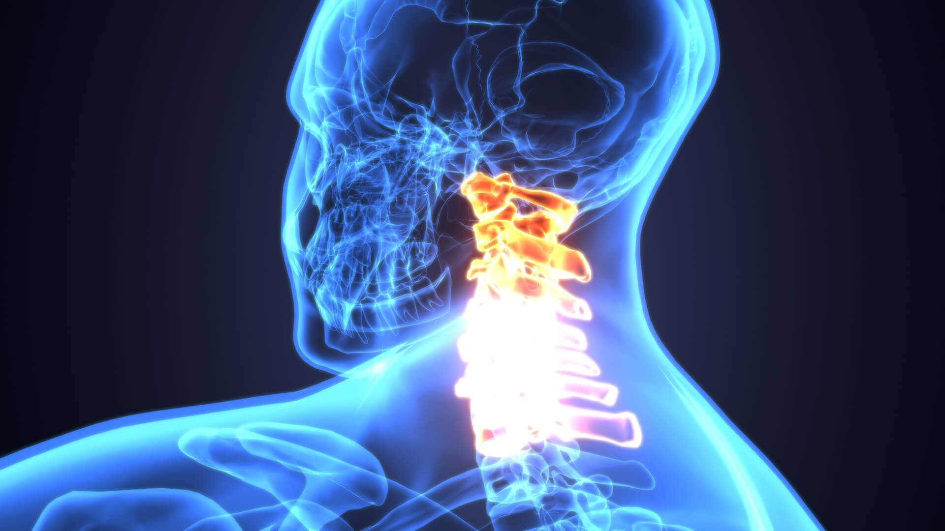 What Is a Spinal Stroke? Symptoms, Causes, and Recovery Explained